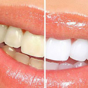 7 thắc mắc thường gặp khi tẩy trắng răng-Yensaodongduong.com